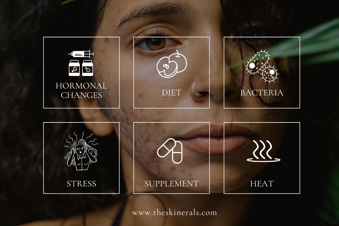 Diet for Acne What Foods to Avoid for Clear Skin in 2025